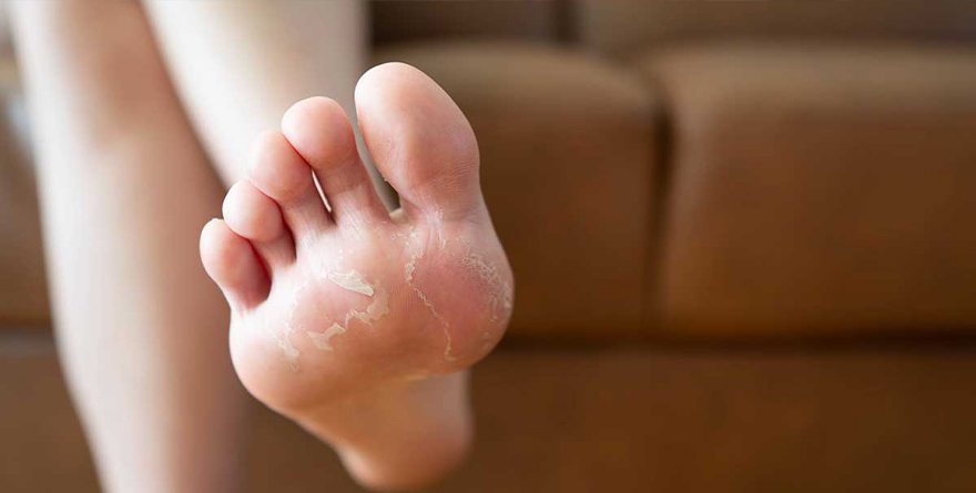 RECOMIENDAN CUIDAR PIES PARA EVITAR INFECCIONES