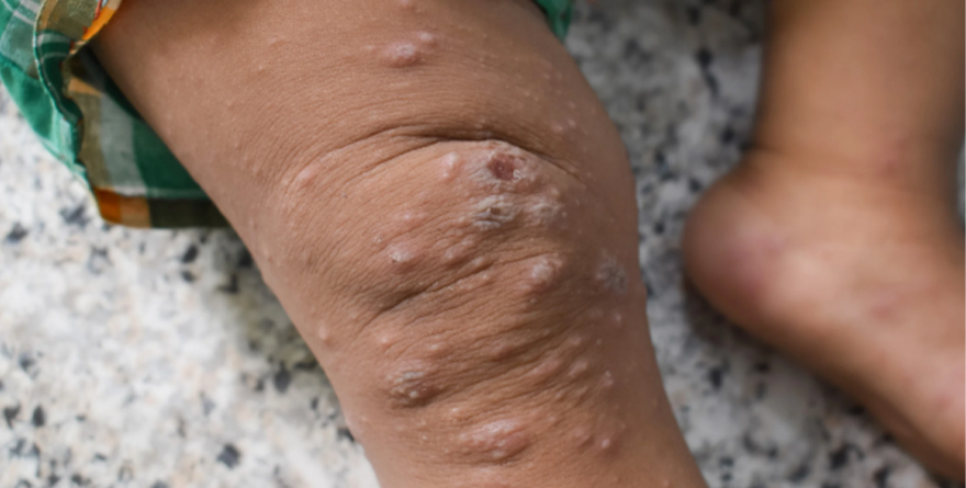 SÍNTOMAS DE MPOX