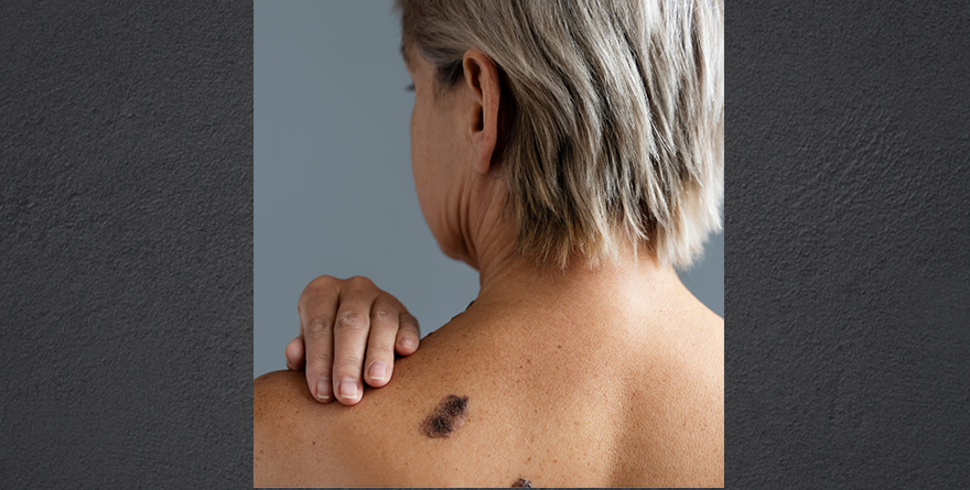 INFÓRMATE SOBRE SARCOMA