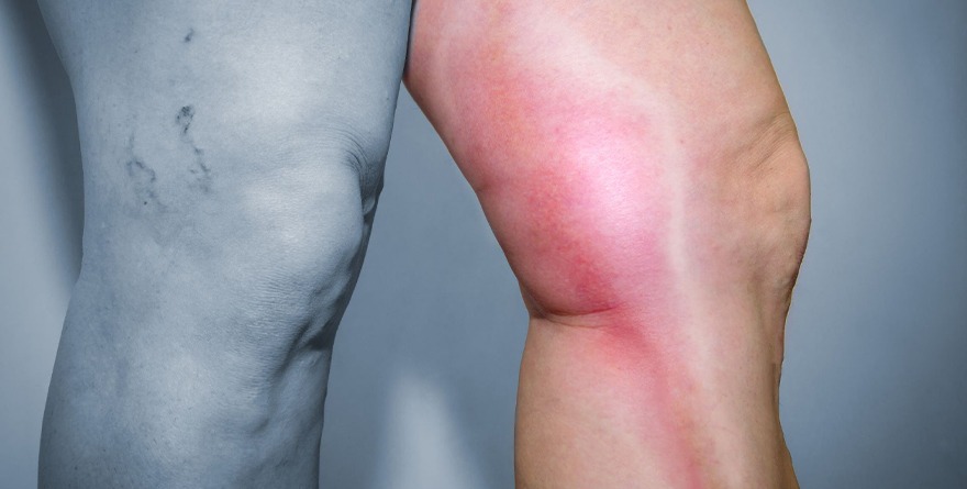 RECONOCER SÍNTOMAS PARA PREVENIR TROMBOSIS