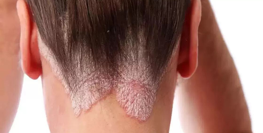 IMPORTANCIA DE RECONOCER Y TRATAR OPORTUNAMENTE PSORIASIS