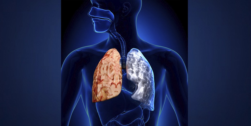 ENFERMEDAD PULMONAR OBSTRUCTIVA CRÓNICA