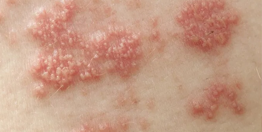 INFÓRMATE SOBRE HERPES GENITAL