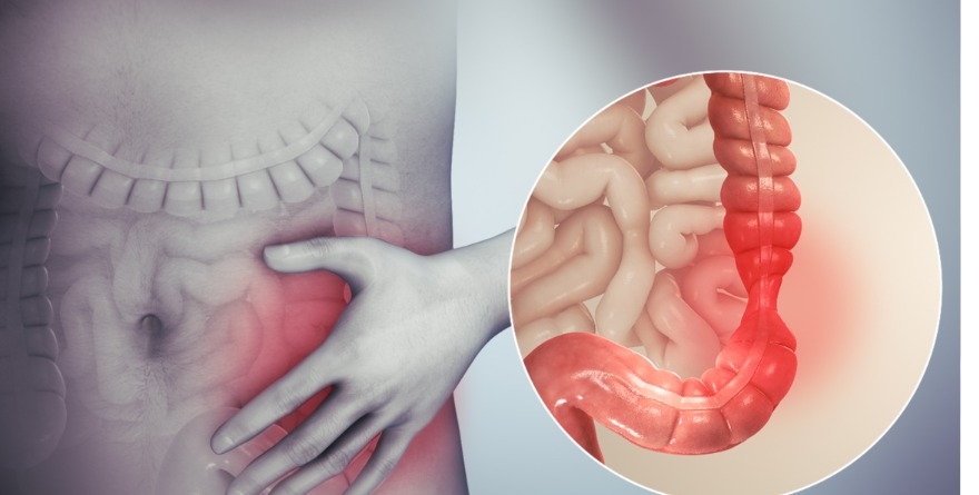 SÍNDROME DEL INTESTINO IRRITABLE