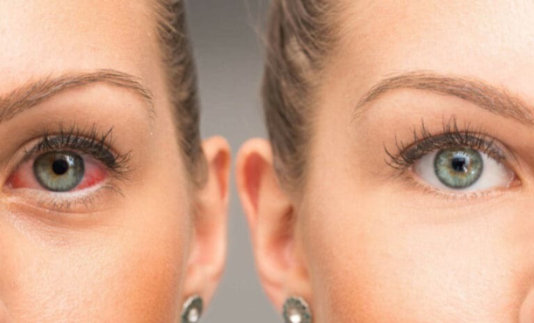 SÍNTOMAS DE GLAUCOMA