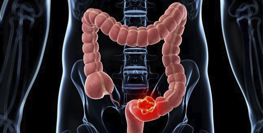 DÍA MUNDIAL CONTRA EL CÁNCER DE COLON Y RECTO
