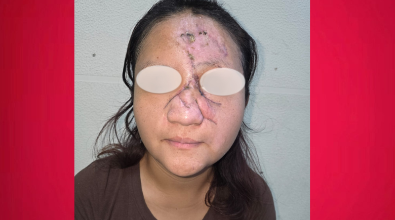 CIRUGÍA COMPLEJA EN VERACRUZ DEVUELVE LA SONRISA A KATIA